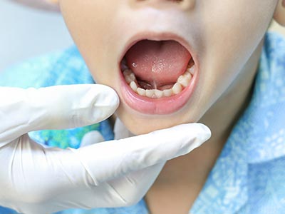 The image shows a young child with an open mouth undergoing dental treatment, with a dental professional s hands visible holding a tool during the procedure.